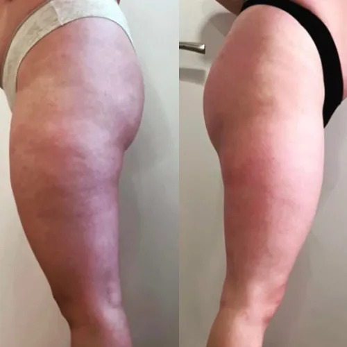 Înainte și după remodelare corporală – reducerea aspectului de coajă de portocală pe coapse