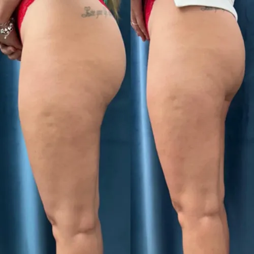 Înainte și după masaj de remodelare – textură mai uniformă a pielii pe coapse